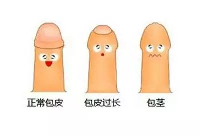 而形成的后天性包茎,经常还伴有尿道口狭窄,在此情况下也需要通过手术